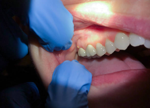 Best Emergency Dentist for Lost Fillings or Crowns in North Eastham, MA